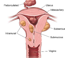 <p>leiomyoma</p>