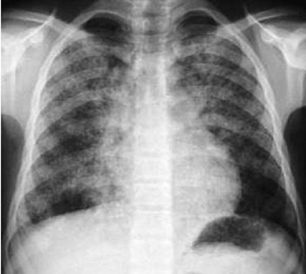 <p>alveolar infilatrate</p><p></p><p><strong>NOTE:</strong> alveolar infiltrates can appear as fluffy or as complete consolidations</p>