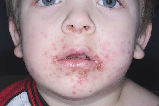 <p>Impetigo</p>