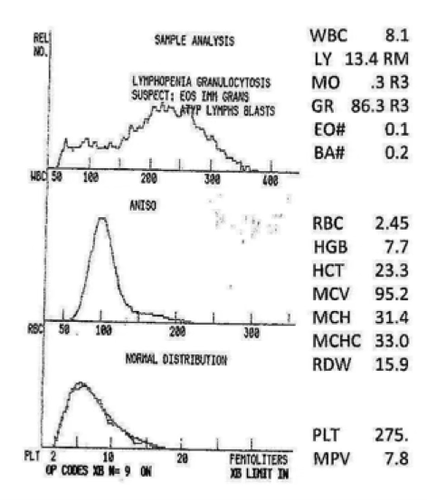 <p>what type of anemia do you expect?</p>