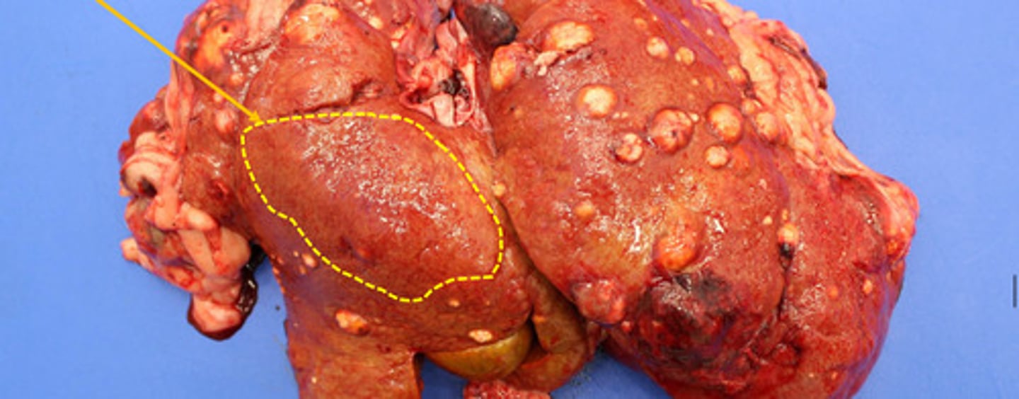 <p>What is the pathology represented by the yellow circle?</p>