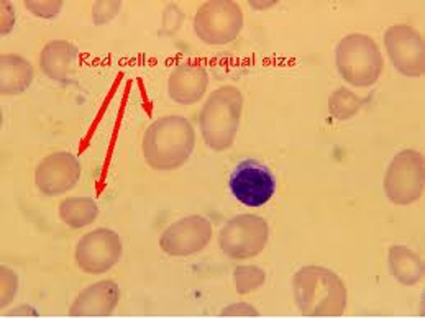 <p>lots of variation in cells (RDW&gt;14.5%) → skew MCV values</p>