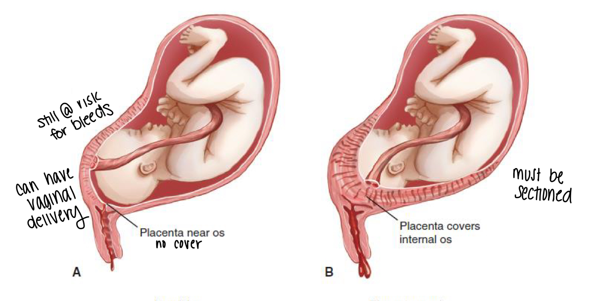 <p>placenta implants over the cervical os </p>