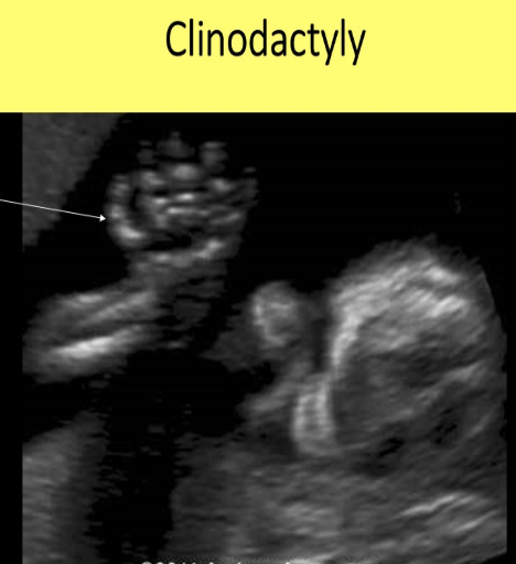 <p>pt has 20w gestation. she has hx of prior pregnancy w/<strong>clinodactyly </strong>[curving of pinky]. what is the best way to evaluate</p><p>.</p><p>a) measure the humerus length</p><p>b) measure the length of the middle phalanx on the 5th digit</p><p>c) assess hands/feet for proper digit formation</p><p>d) evaluate the cranial anatomy for cerebral clefts</p>