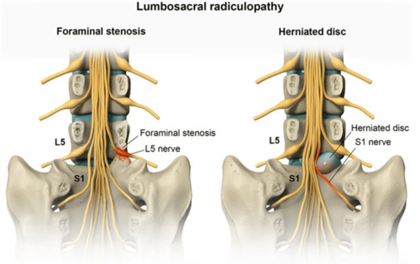 <p>What are the signs of a lumbrosacral radiculopathy?</p><p>- numbness, paresthesias, weakness in the distribution of a specific lumbar or sacral spinal nerves</p><p>What is the pathophysiology of a slipped disc (ie: lumbrosacral radiculopathy)? What nerve level tends to be pinched?</p><p>- often due to invertebral disc herniation in which the nerve associated with the inferior vertebral body is impinged</p><p>- ie: herniation of the L3/L4 disc affects the L4 spinal nerve</p><p>Which direction do the intervertebral discs tend to herniate?</p><p>- generally herniate posteriolaterally</p><p>- this is because of the thing posterior longitudinal ligament and THICK anterior longitudinal ligament along the midline of the vertebral bodies</p>