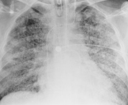 <p>patchy, ill defined areas of fluid throughout both lungs, unlike pulmonary edema with CHF (congestive heart failure), heart remains normal size</p>