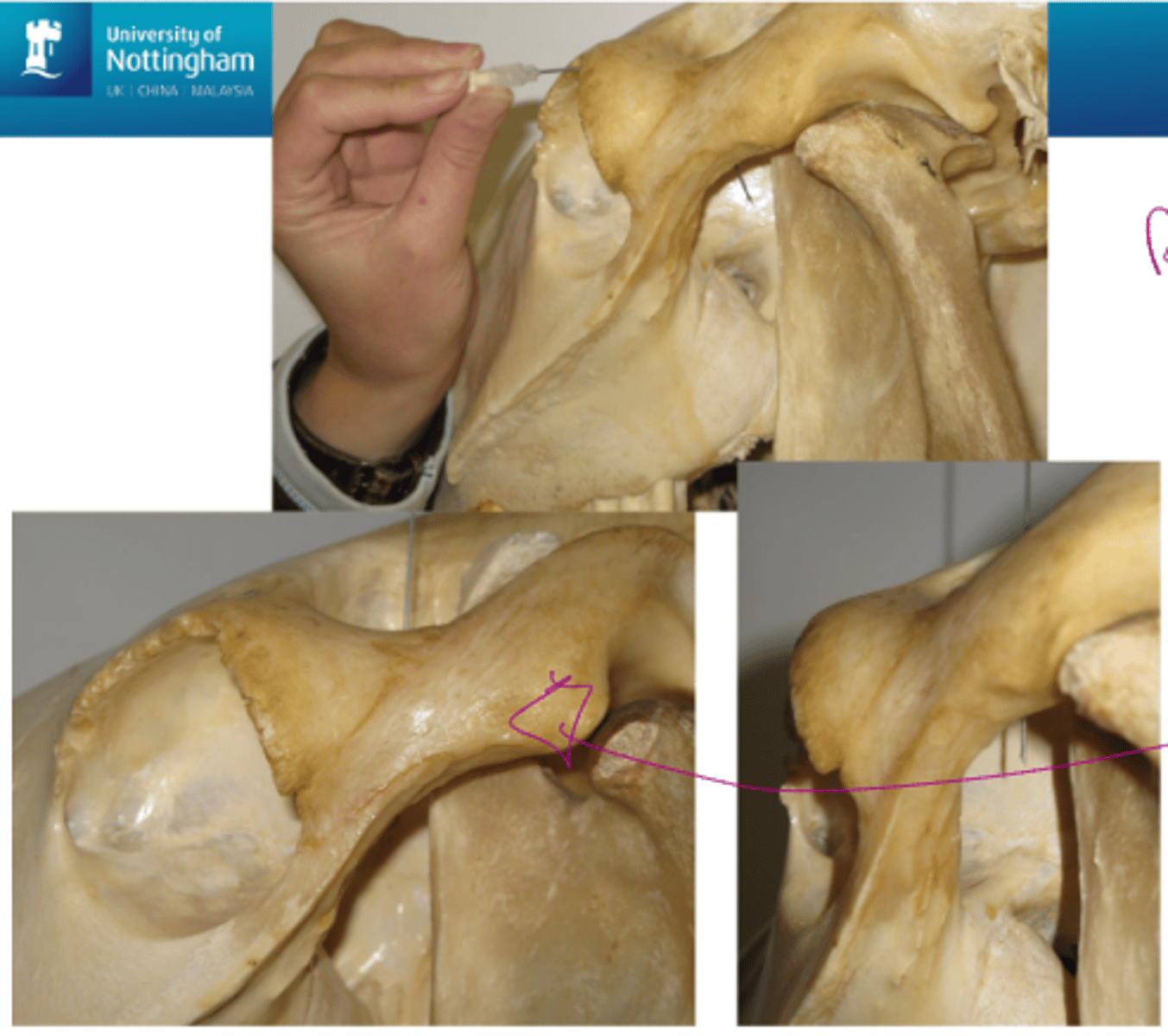<ul><li><p><span><span>Getting needle to back of the horses eye</span></span></p><ul><li><p><span><span>Curve a spinal needle to the same curvature of the globe so it goes round to the back of the eye</span></span></p></li><li><p><span><span>But if are pushing through an area that might be neoplasia or infection you can push it to the back of the eye</span></span></p></li></ul></li><li><p><span><span>Go through the supraorbital fossa</span></span></p><ul><li><p><span><span>Go down in that space on the top of the horses skull putting a straight spinal needle down there so it comes out at the back of the eye</span></span></p></li></ul></li></ul><p></p>