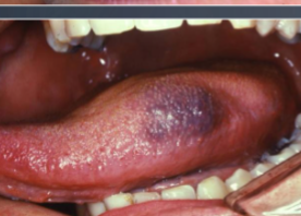 <p>accumulation of blood within tissues producing a mass </p>