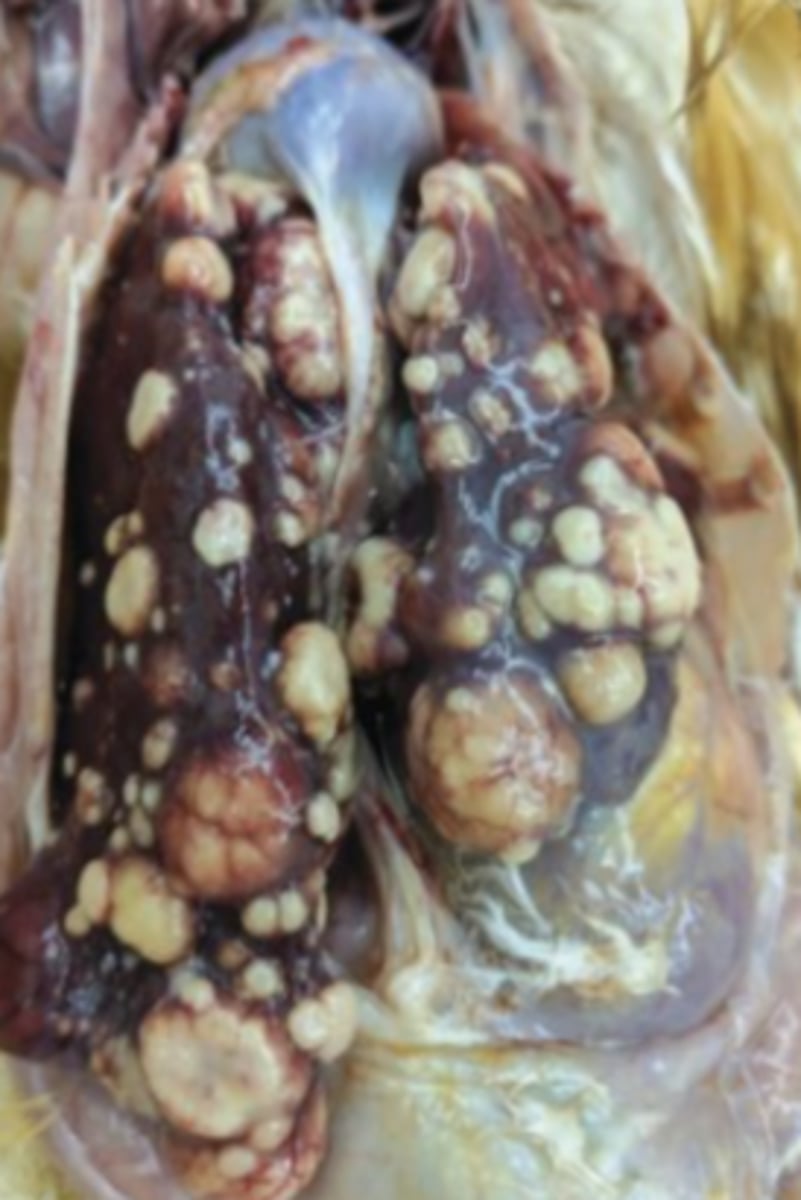 <p>What kind of tumor is this? (broad category)</p>