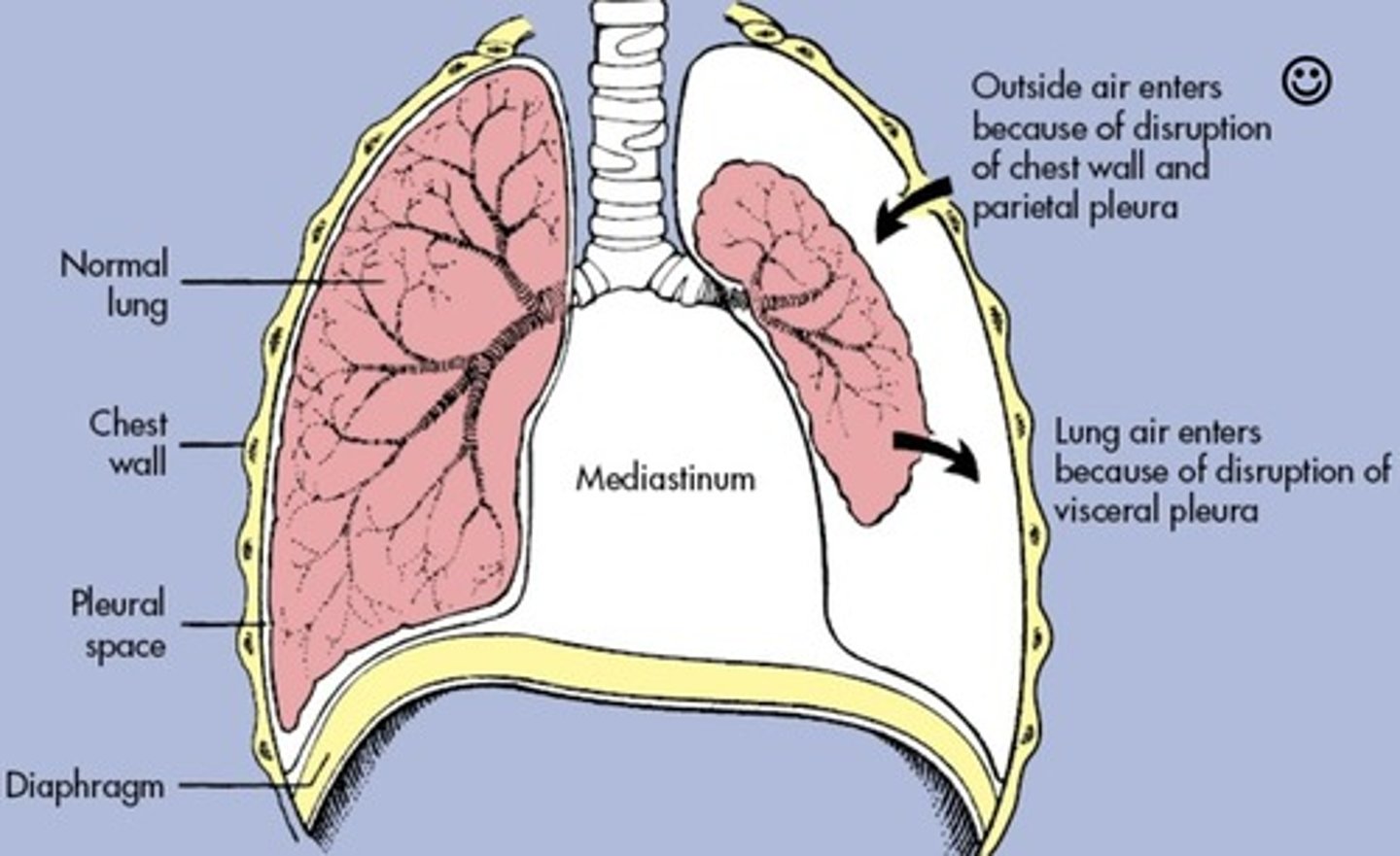 <p>Condition where air accumulates in the space between lung and chest wall.</p>