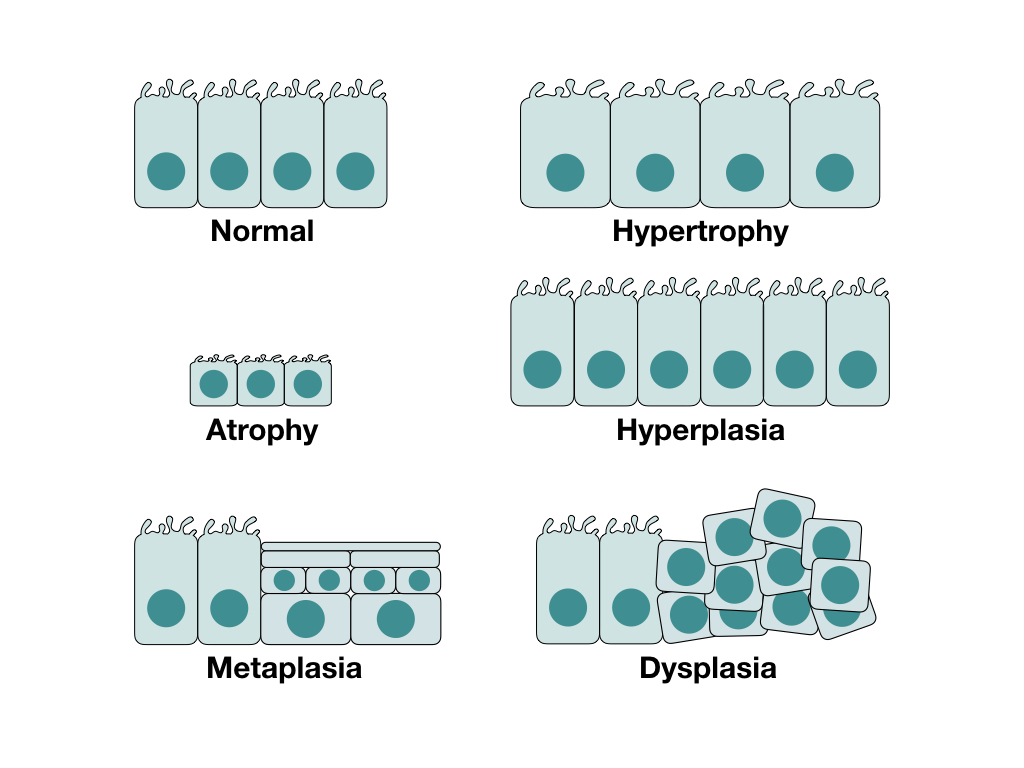 <p>hyperplasia: increased number of cells<br>only in cells capable of mitosis</p><p>metaplasia: chronic irritation/inflammation→one cell type replaces another<br><strong>reversible</strong><br>maybe precancerous</p><p>dysplasia: deranged cell growth→varied size/shape/organization<br>maybe reversible<br><strong>strong precursor to cancer</strong></p><p>normal→hyperplasia→dysplasia→cancer</p>