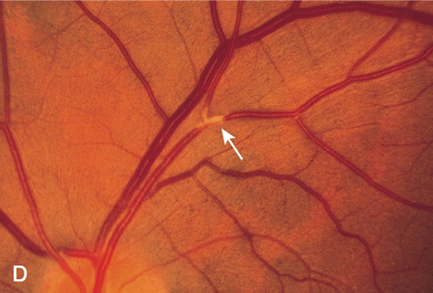 <p><u>Etio:</u> <strong>Abrupt monocular loss of vision (partial or complete) that <mark data-color="#fffb00" style="background-color: #fffb00; color: inherit">lasts only a few minutes, caused by an emboli if vascular</mark></strong></p><p><u>Risk Factors</u>: DM, HTN, hyperlipidemia, giant cell arteritis, migraine</p><p><u>Complications</u>: <strong>central retinal artery occlusion, <mark data-color="#fdff00" style="background-color: #fdff00; color: inherit">stroke</mark></strong></p><p><u>Testing:</u> complete ocular, cardiac, and neuro exam</p><p><u>Tx</u>: tx underlying cause</p>