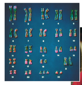 <p>Down syndrome results from the presence of an extra copy of chromosome 21</p>