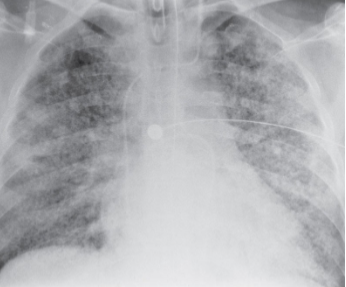 <p>Acute respiratory distress syndrome</p>