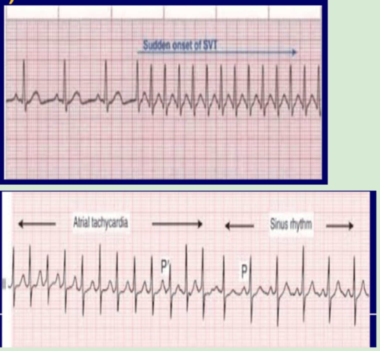 <p>Abrupt onset</p><p>Abrupt offset</p>