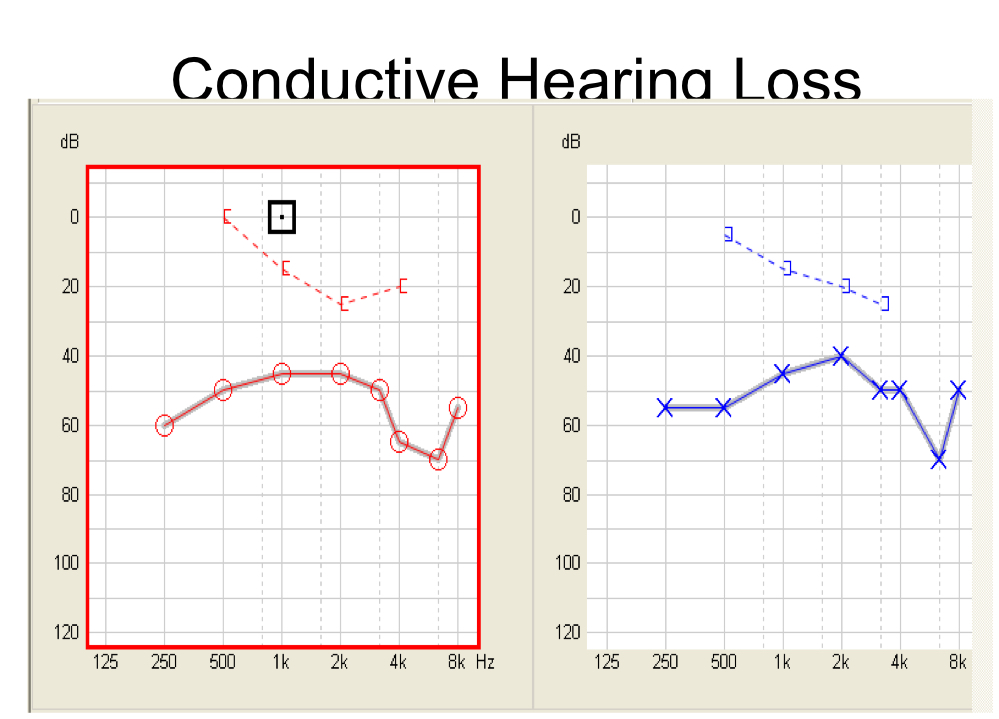 conductive hearing loss