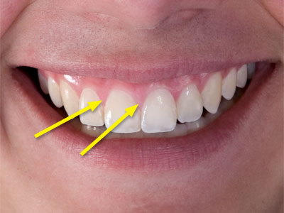 <p>Triangular shaped crests of gingival tissue located between the teeth. These crests of tissue consist of free and attached gingiva </p>