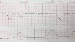 <p>Intermittent and periodic slowing of the fetal heart rate with a variable time in relation to the contraction.</p>
