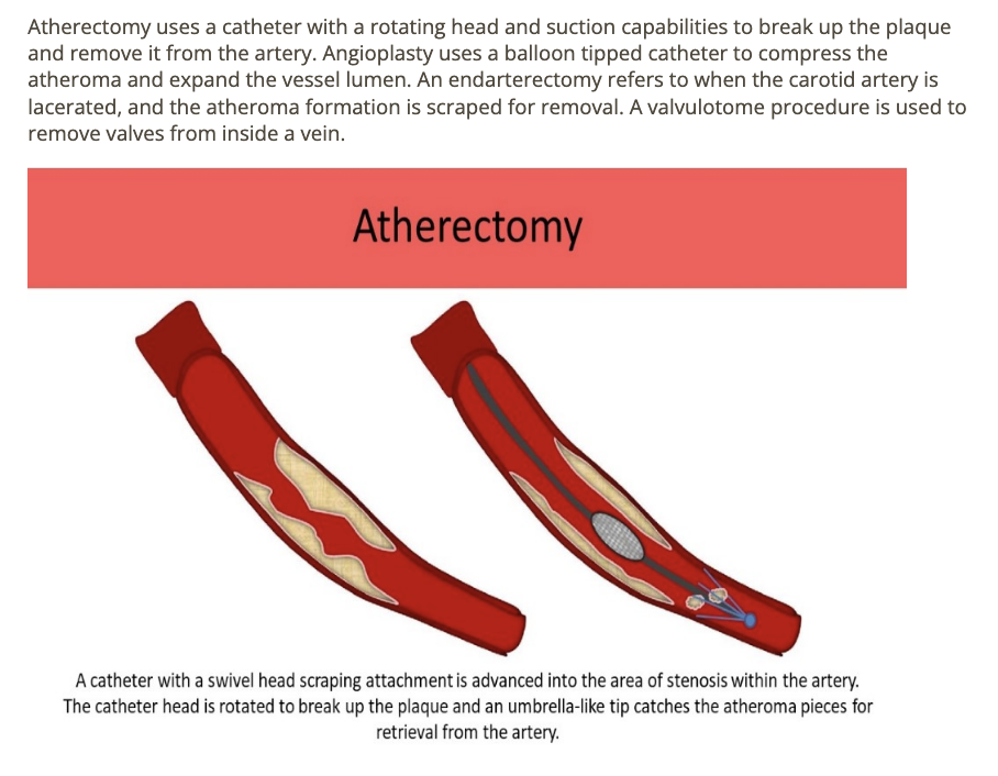 <p>b) atherectomy </p>