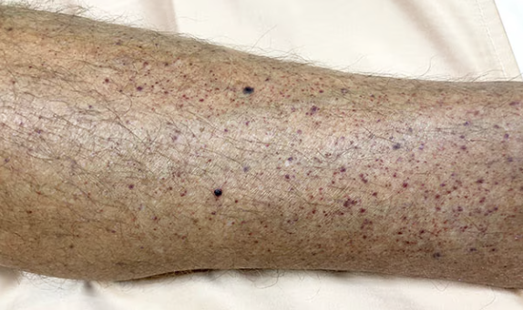 <p>what type of vascular skin lesion is this?</p>