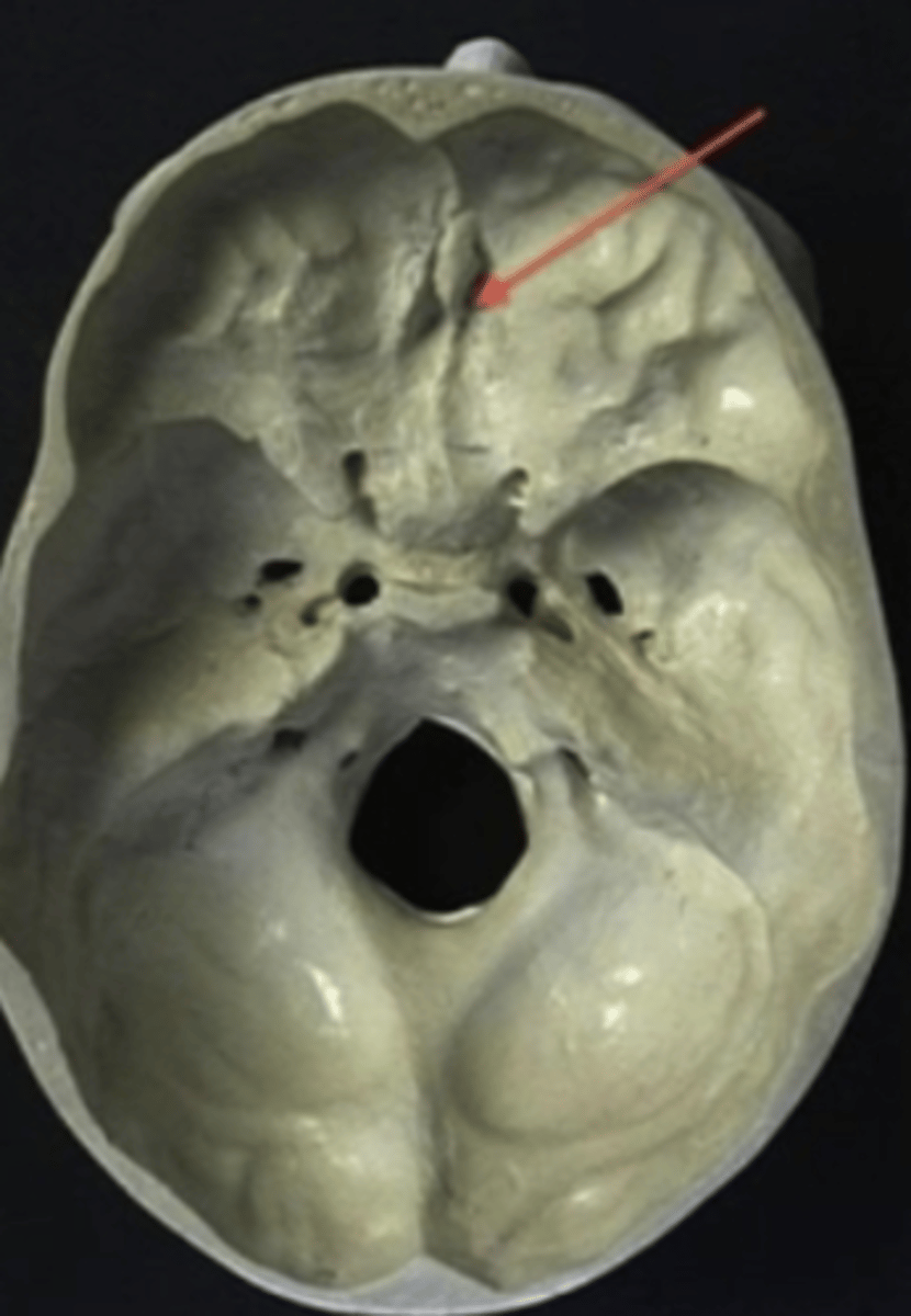 <p>cribriform plate of the ethmoid bone</p>