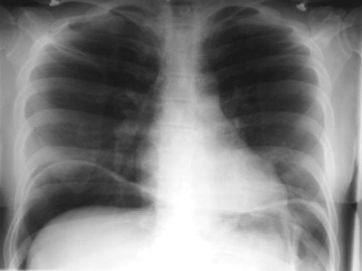 <p>what is this CXR diagnostic of?</p>