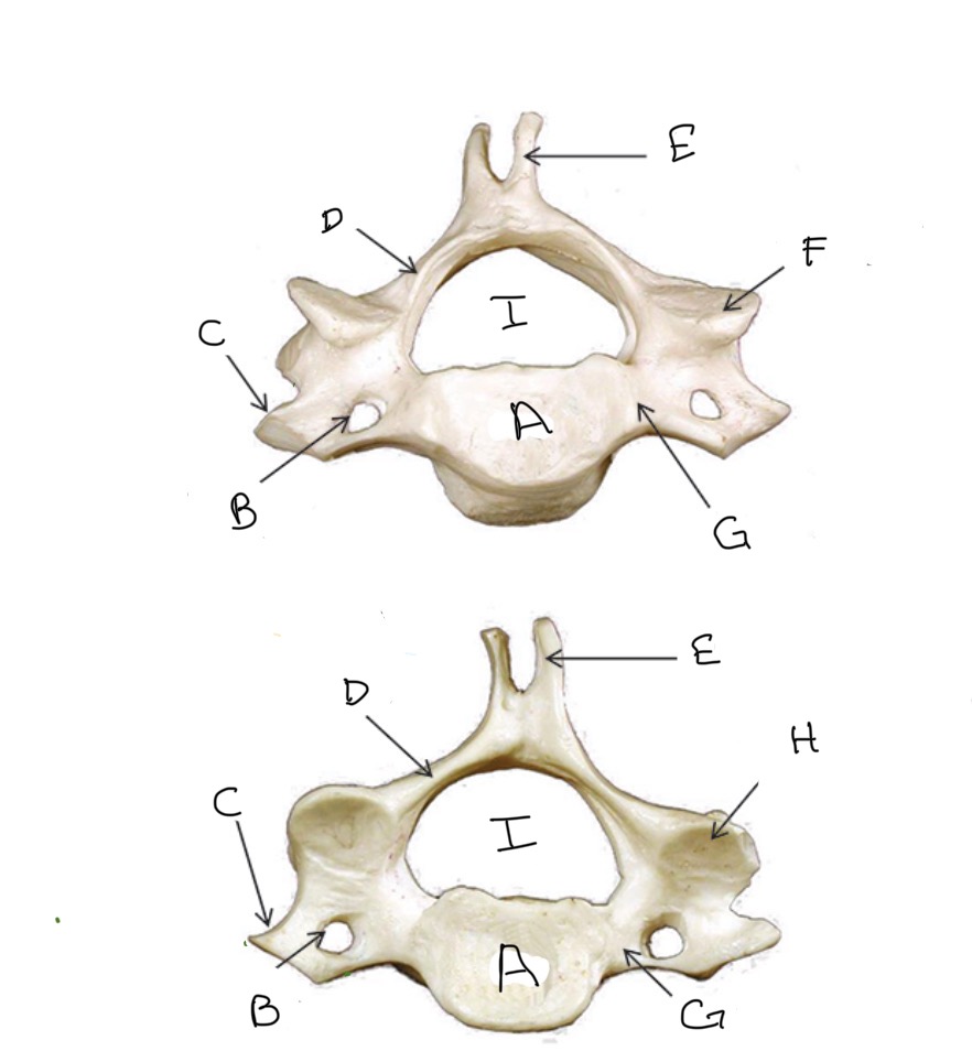 <p>Type of Bone: Cervical Vertebrae</p><p>What is A?</p>