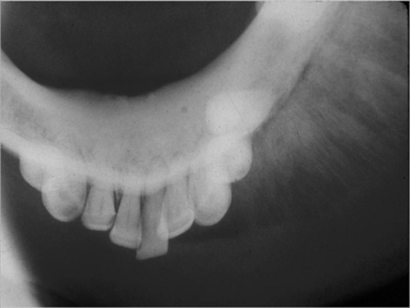 <p>common locations: head and jaws 8%</p><p>clinical features: there is usually pain at first</p><p>radiographic: mixed opaque lesion w ill-defined borders; symmetrical widening of the PDL; sunburst pattern of bone growth above the crestal bone</p><p>TX: it metastasizes to the lung/brain</p><p>prognosis: death</p><p>population: YA; males</p>