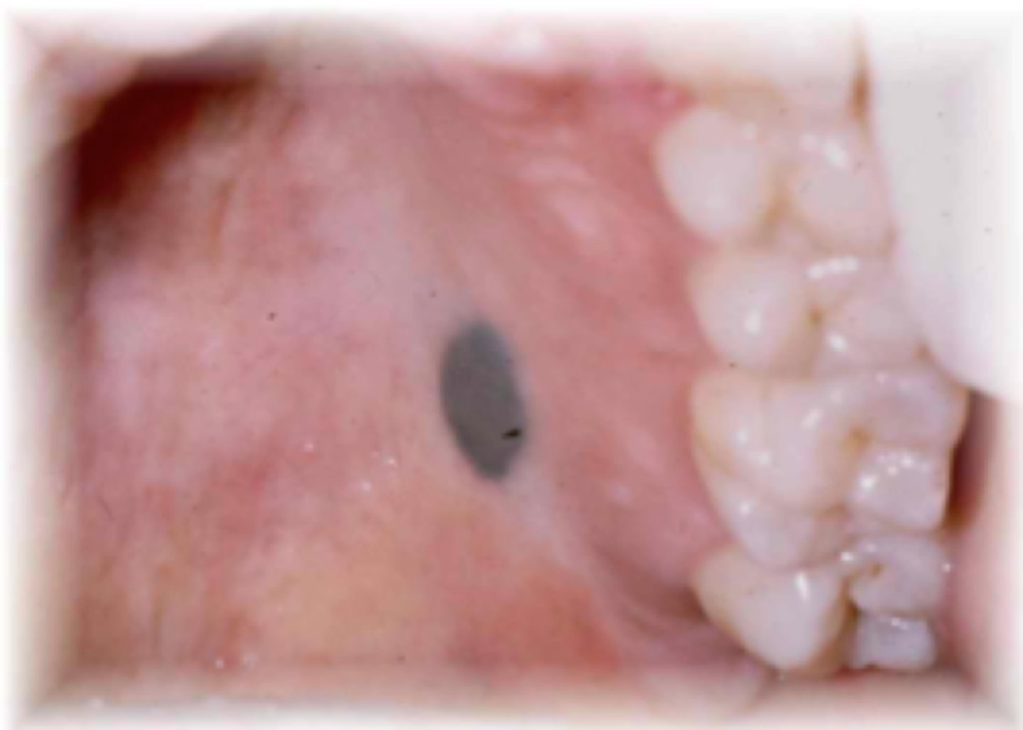 <p>well-defined, single, brown-black macule</p><p>• rare intraorally</p><p>• proliferation of melanocytes</p><p>• uniform color</p><p>• less than 6mm</p><p>• aka MOLE</p>