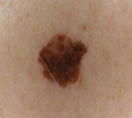 <p>a flat, discolored spot on the skin that is less than 1 centimeter in diameter. </p>