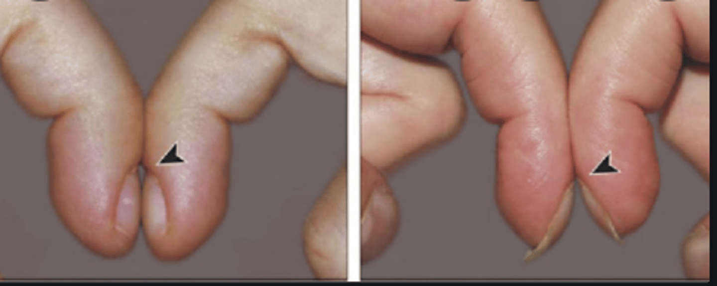 <p>_____'s sign is the absence of the diamond-shaped space between the finger tips in a patient with digital clubbing.</p>