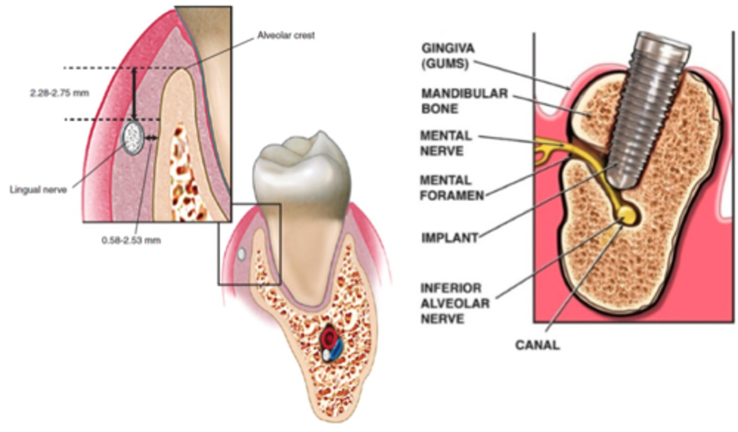 <p>Yes, nerve injury is still possible even with proper planning.</p>