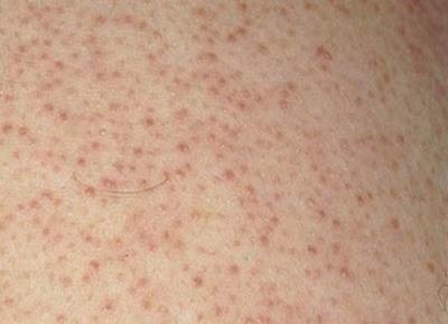 <p>Redness and bumpiness in the cheeks or upper arms; caused by blocked follicles</p>