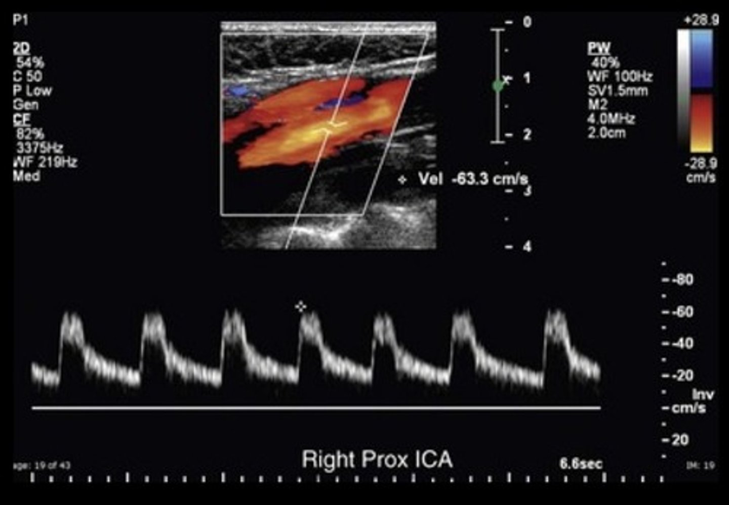 <p>Low resistant - except prox. CCA &amp; ECA</p><p>High off baseline</p><p>Spectral window</p><p>Continuous forward flow</p>