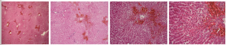 <p><strong>Hepatitis purulenta acuta parenchymatosa </strong>(traumatic disease of forestomach)</p><ul><li><p>on the slide - cross section of cow liver with advanced traumatic reticuloperitonitis </p></li></ul><p></p>