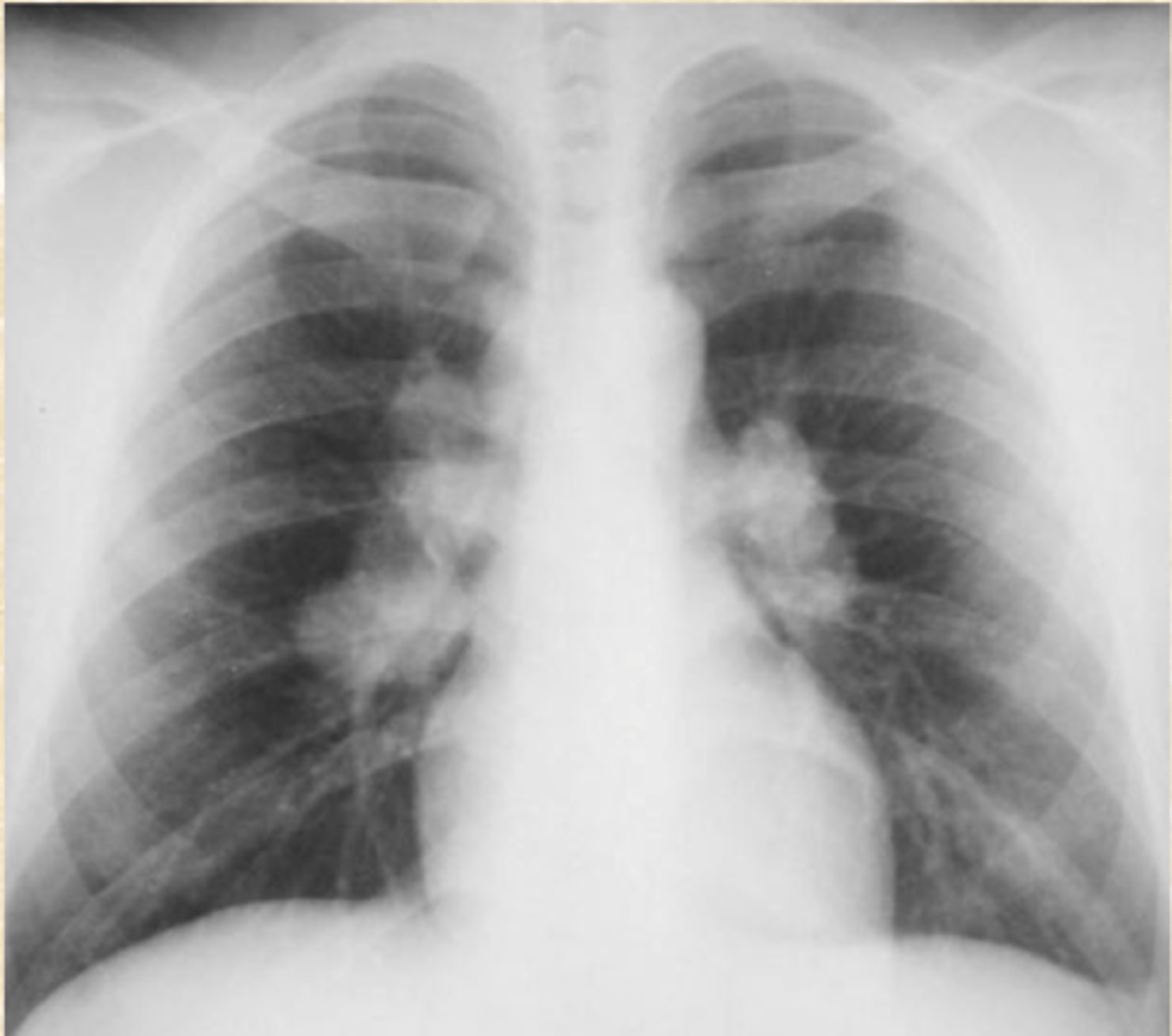 <p>What does this CXR show?</p>