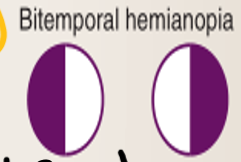 <p>Bitemporal hemianopia</p>