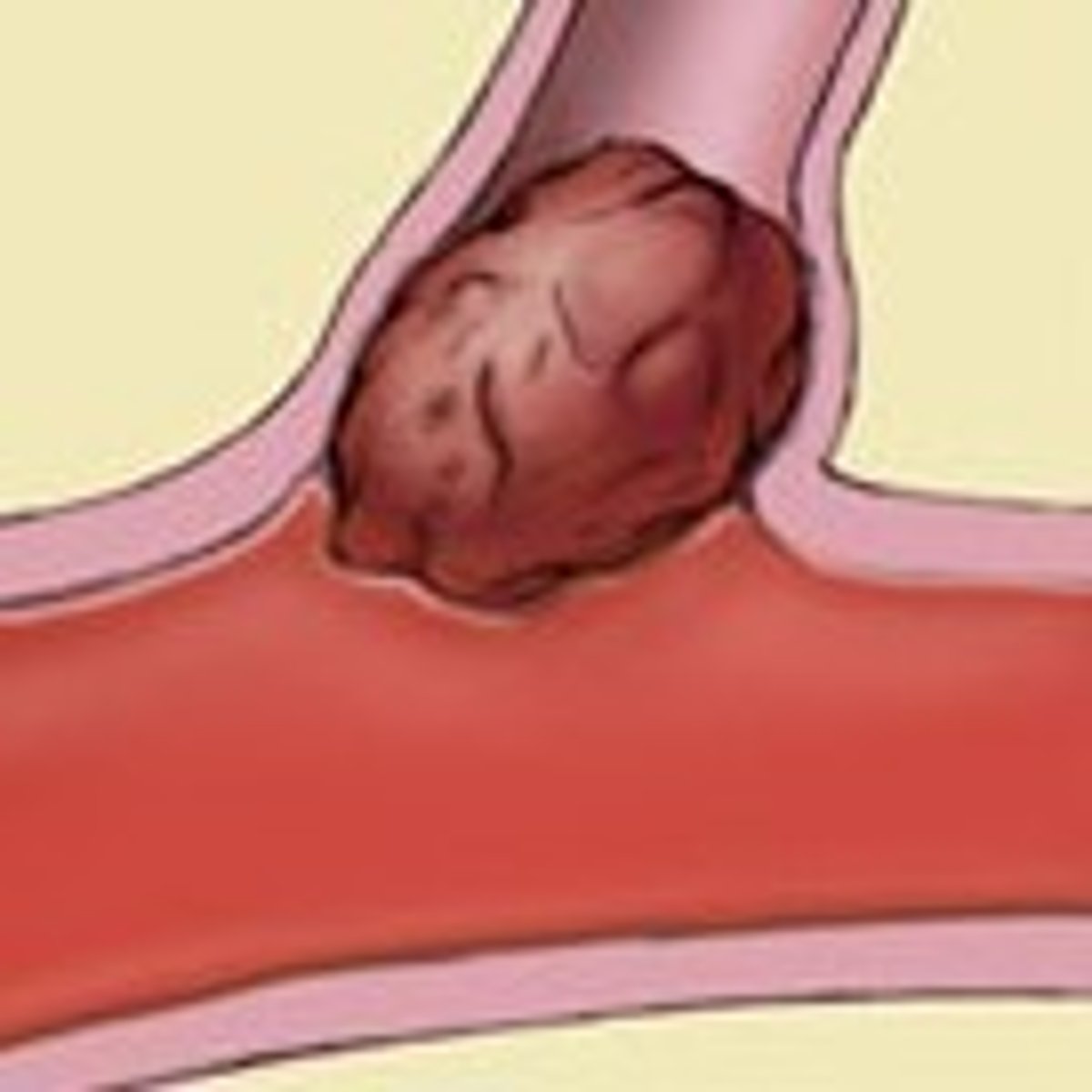 <p>insertion, stopper, plug, embolus</p>
