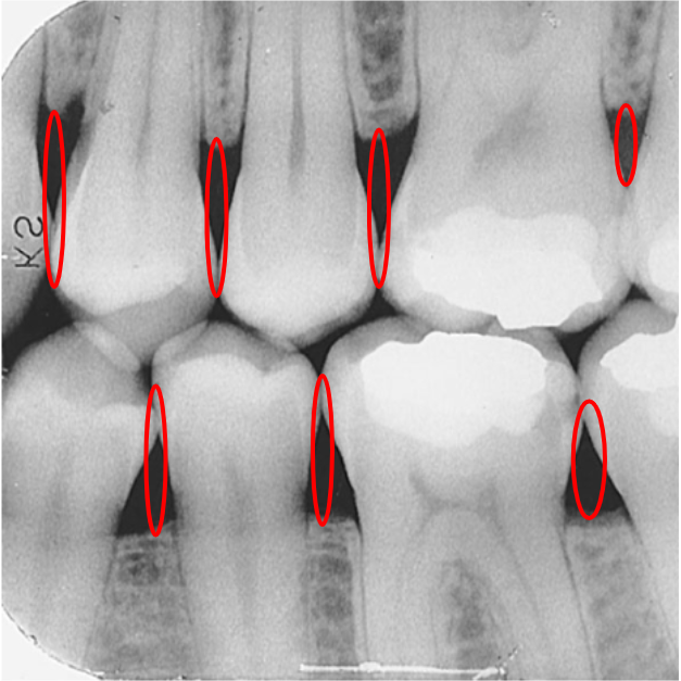 <p>The area between two adjacent teeth.</p>