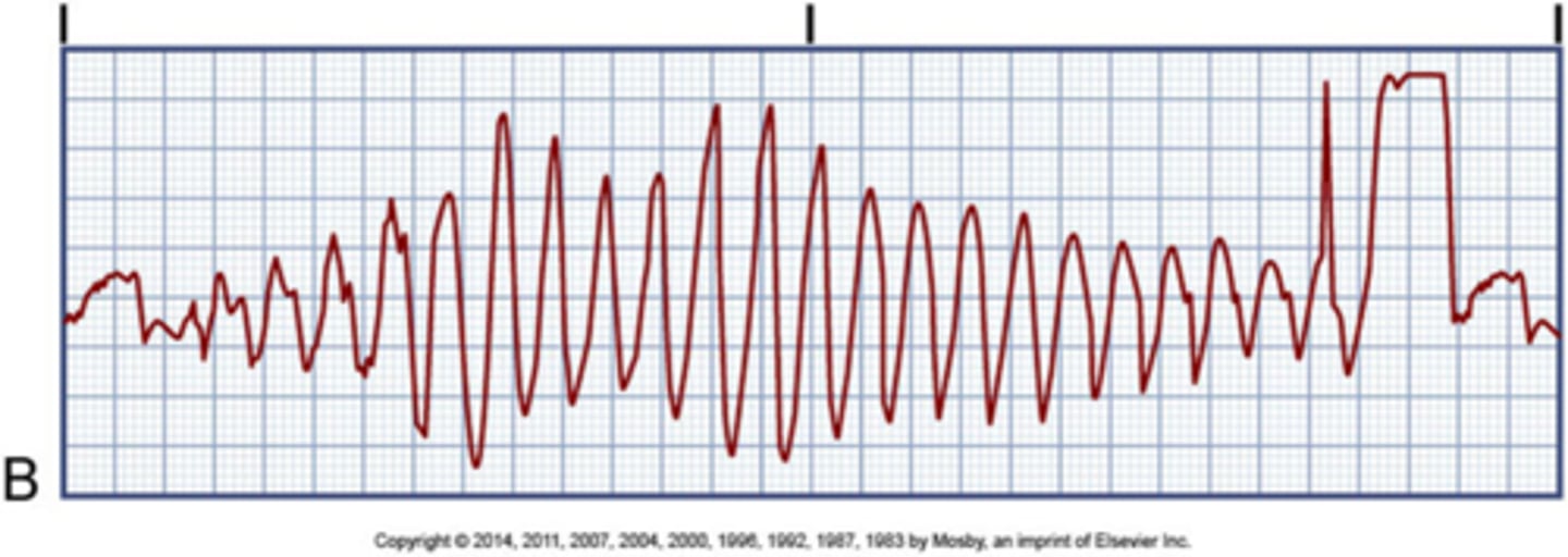 <p>constant change on QRS complex (usually Mg problem)</p>