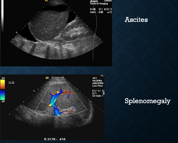 <p>ascites</p><p>splenomegaly</p><p>GI bleeding</p><p>hepatic encephalopathy </p><p>underlying liver disease</p>