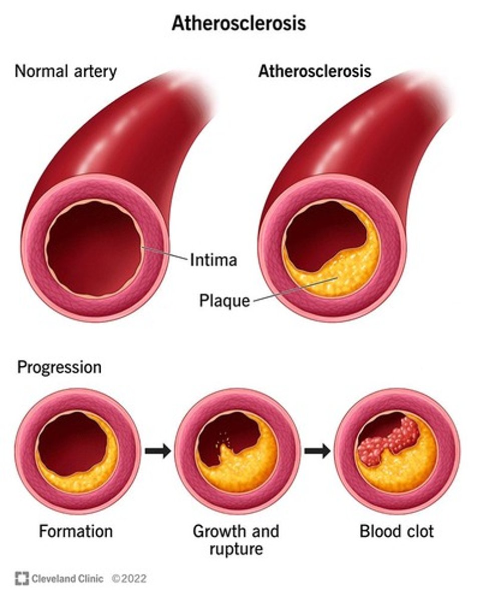 <p>Atherosclerotic plaque erosion, rupture, or other types of plaque disruption.</p>
