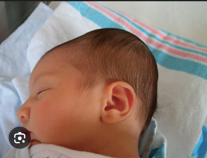 <p>Collection of blood beneath periosteum due to birth trauma. Does not cross suture lines</p>