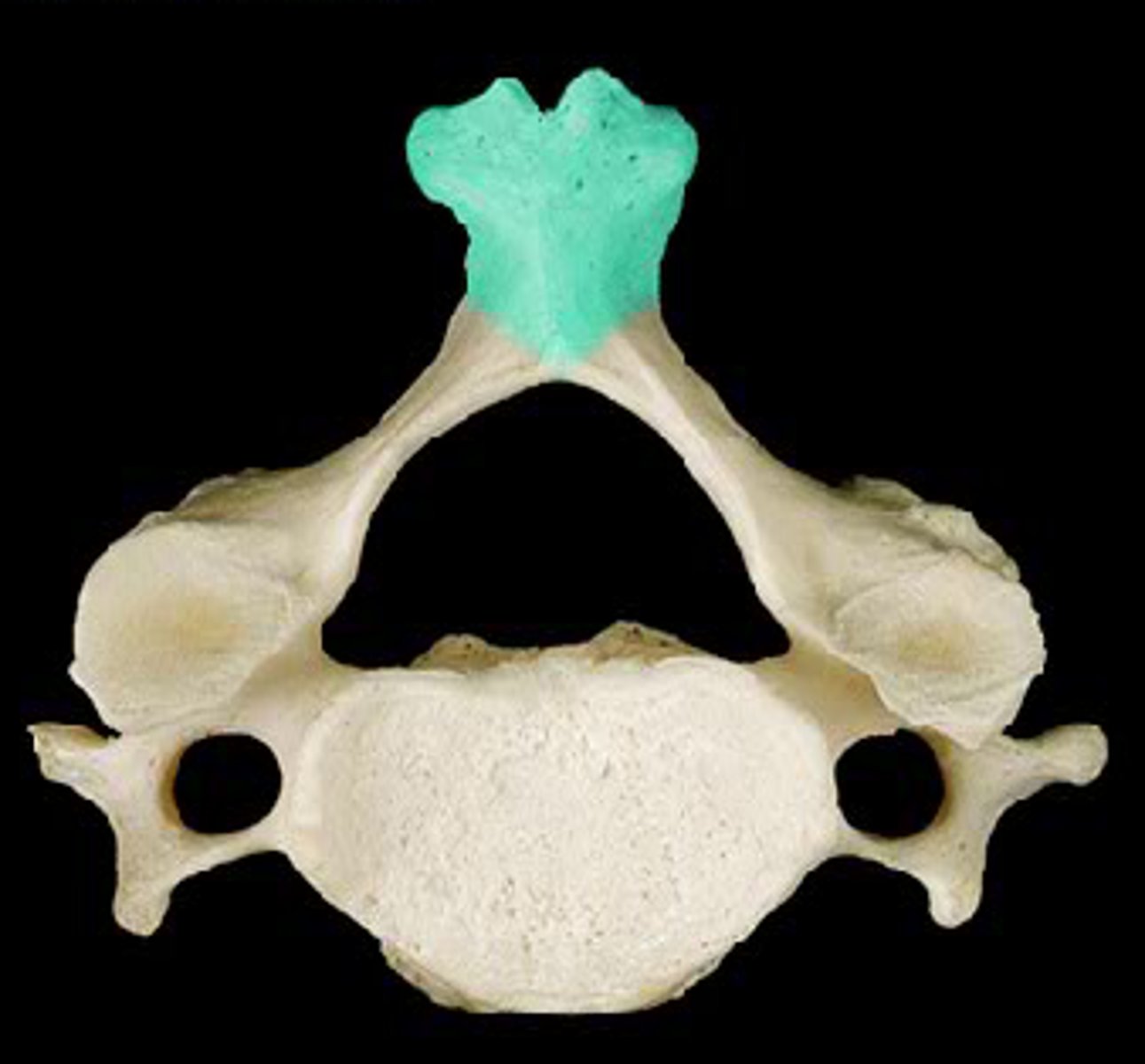 <p>Cervical vertebrae have a __________ spinous process.</p>