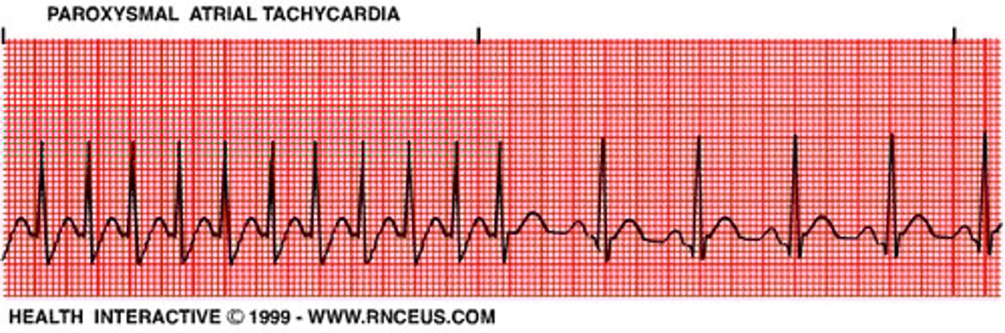 <p>Multiple PACs in a row</p><p>Onset and termination are sudden and abrupt</p><p>HR = 150-250 bpm</p>