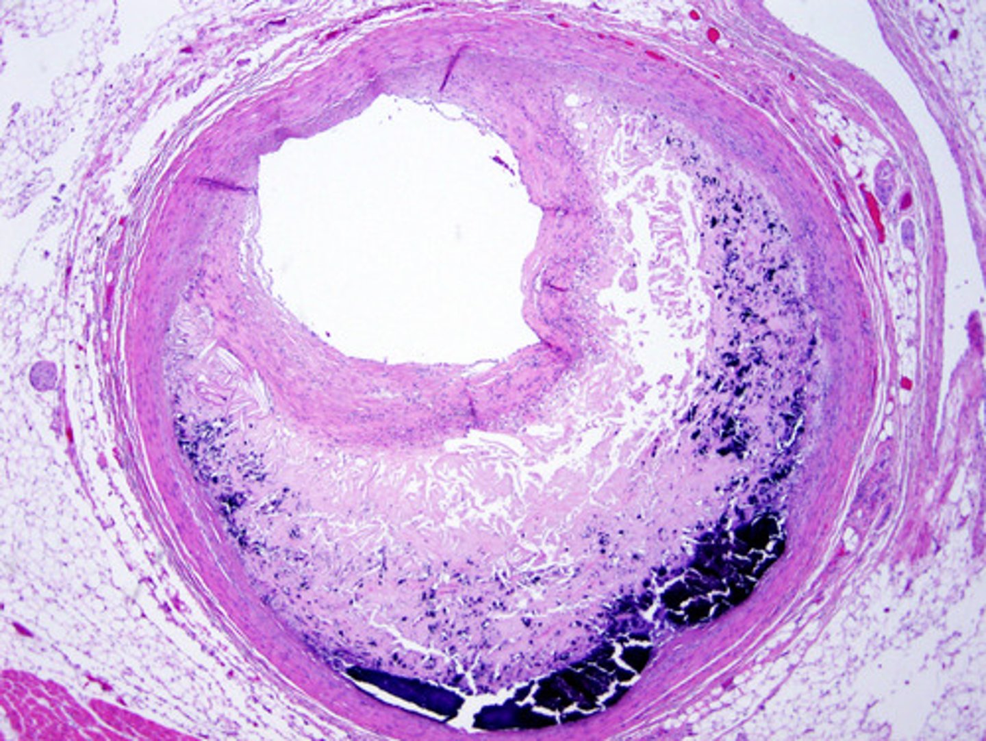 <p>condition in which fatty deposits called plaque build up on the inner walls of the arteries (microscopic - the main identifier is the needle-like cholesterol clefts noted within the lumen</p>