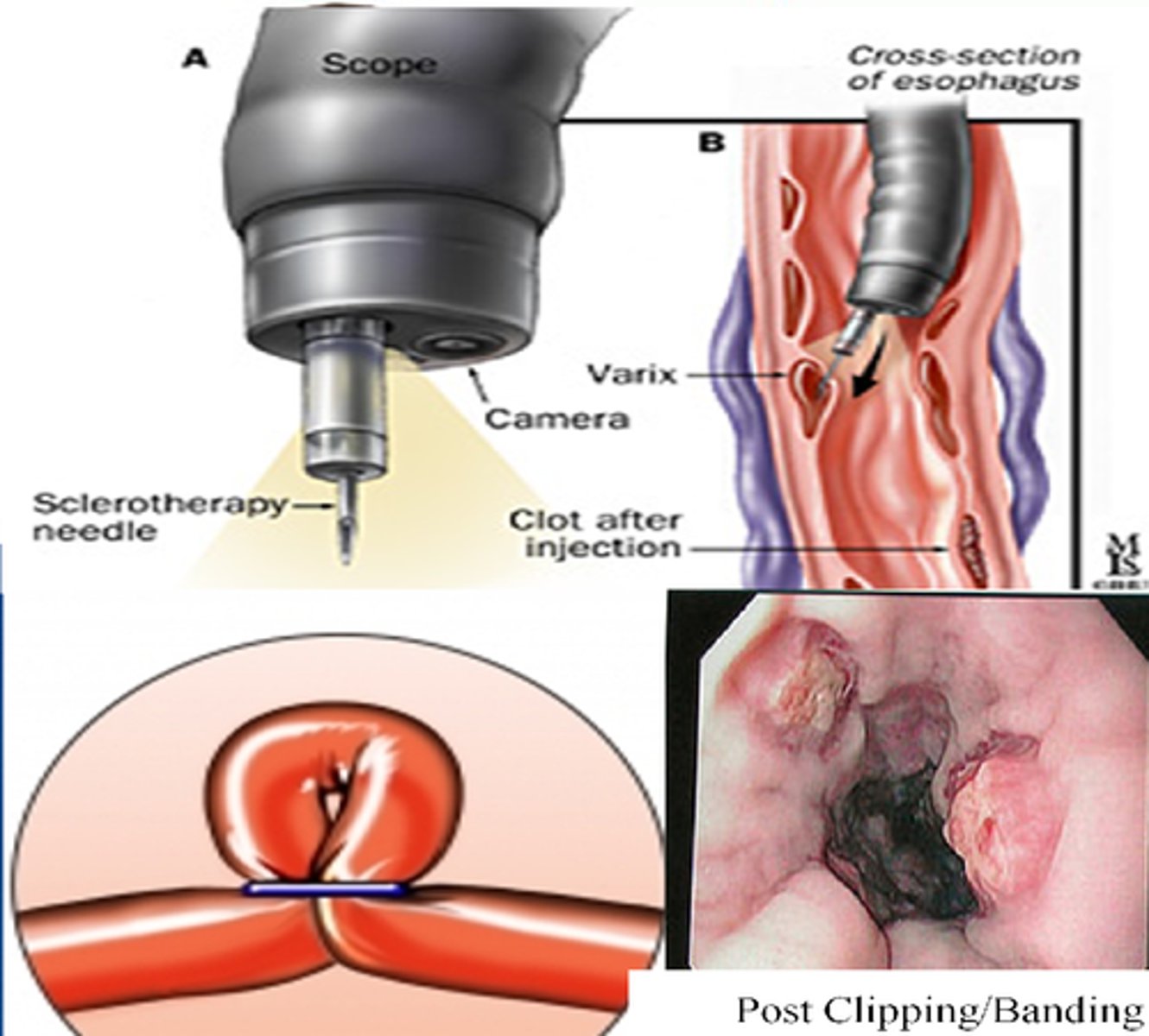 <p>can cause smaller vessels to disappear; treatment for varicose veins</p>