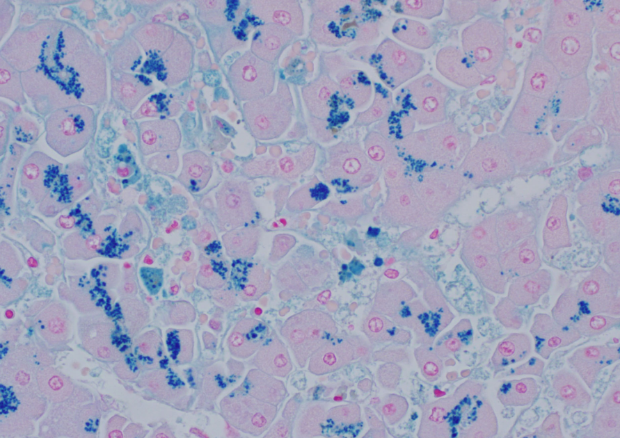 <p>Special stain for Iron disease storage- what diseases does this include?</p>