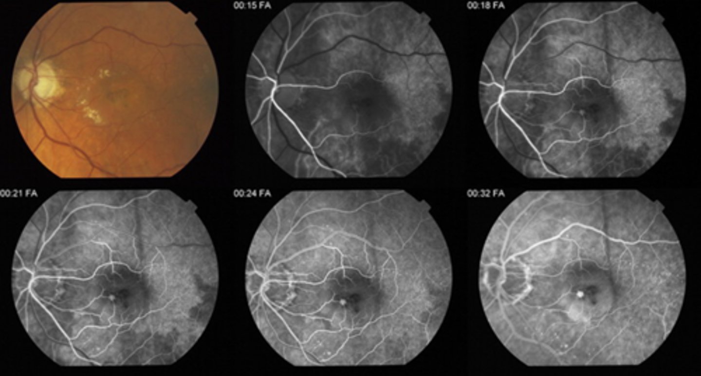 <p>1. choroidal flush noted after 12-20 sec = delayed arm to eye time </p><p>2. patchy choroidal flush</p><p>3. delayed filling of a branch like in a BRAO</p>