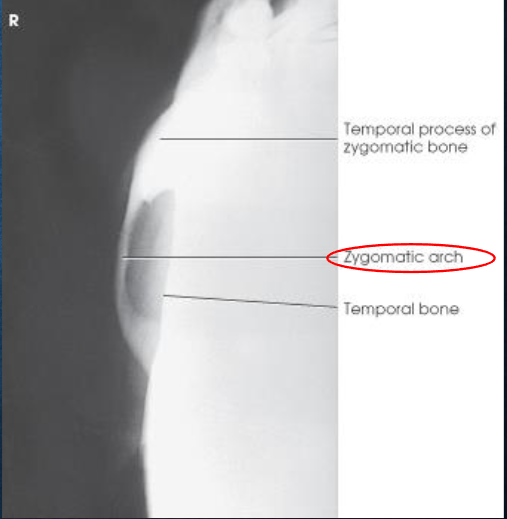 <ul><li><p>one zygomatic arch free of superimposition</p></li><li><p>arch not overexposed</p></li></ul><p></p>